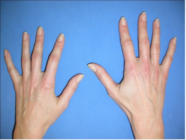rheuma arthritis symptome